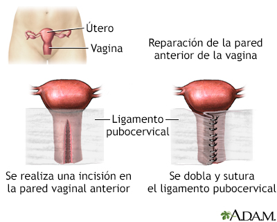 Reparación de la pared vaginal anterior - Miniatura de ilustración
              