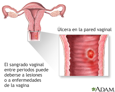 Sangrado entre periodos