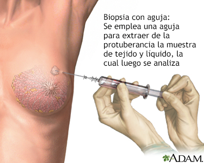 Biopsia con aguja del seno