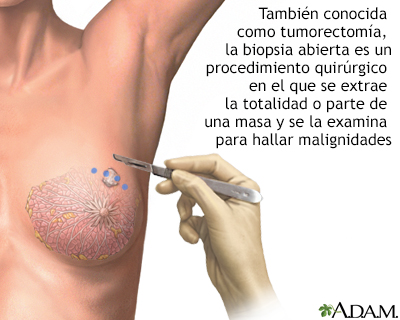 Biopsia abierta del seno - Miniatura de ilustración
              