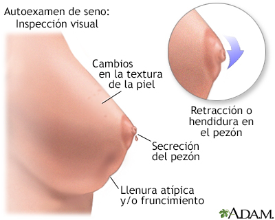 Autoexamen de seno - Miniatura de ilustración
              