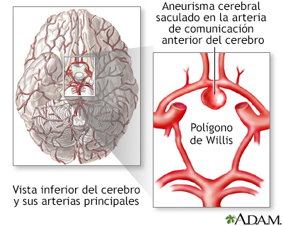 Aneurisma cerebral - Miniatura de ilustración
              