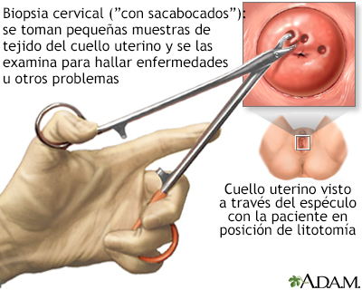 Biopsia cervical