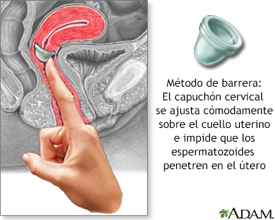 El capuchón cervical - Miniatura de ilustración              