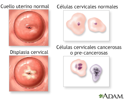 Neoplasia cervical