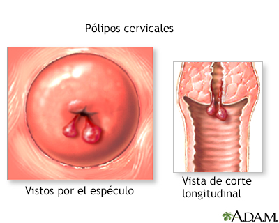 Pólipos cervicales