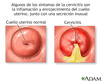 Cervicitis - Miniatura de ilustración
              