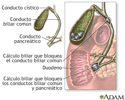 Coledocolitiasis - Miniatura de ilustración
              