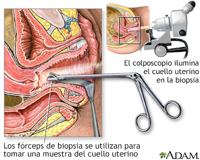 Biopsia dirigida por colposcopia