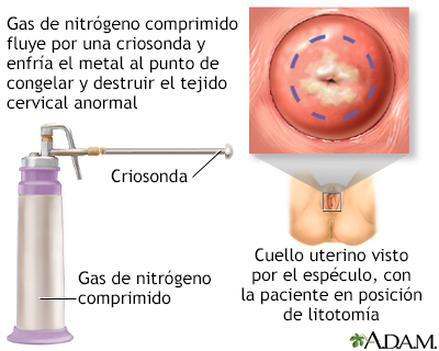 Criocirugía cervical - Miniatura de ilustración
              