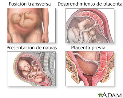 La cesárea en el parto. Cómo recuperarse de una cesárea rápido