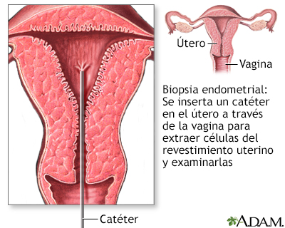 Biopsia endometrial