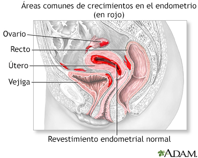 Endometriosis - Miniatura de ilustración
              