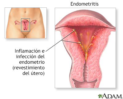 Endometritis - Miniatura de ilustración
              