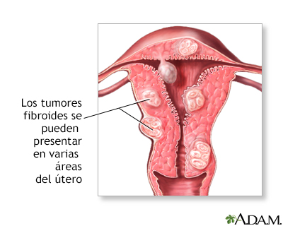 Tumores fibroides