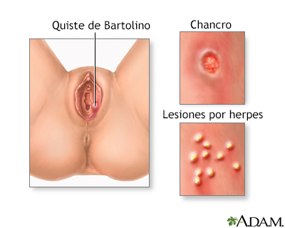 Llagas genitales (en mujeres) - Miniatura de ilustración
              