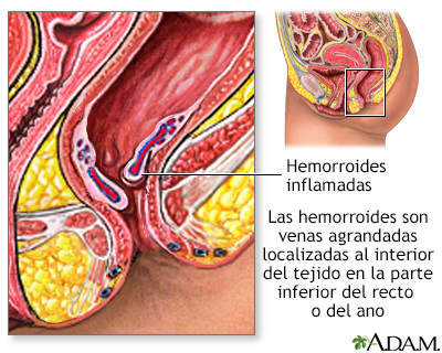Hemorroides - Miniatura de ilustración
              