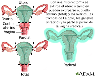 Histerectomía - Miniatura de ilustración              