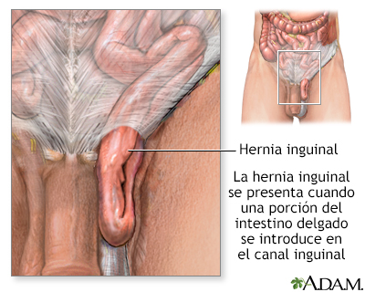 Hernia umbilical y hernia inguinal: síntomas y operación - Tani Salud