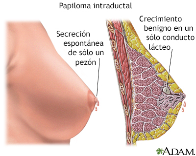Papiloma intraductal