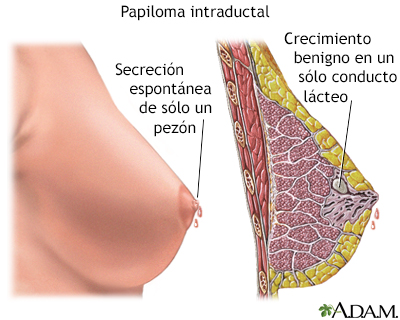 Papiloma ductal benigno