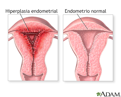 Periodos menstruales anormales - Miniatura de ilustración
              