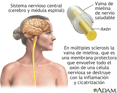 Esclerosis m&#250;ltiple - Miniatura de ilustración
              