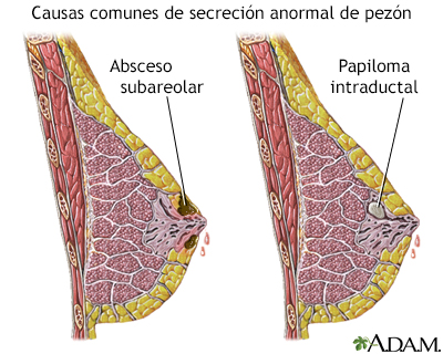 Papilomatosis intraductal