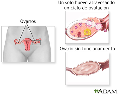 Hipofunción ovárica - Miniatura de ilustración              