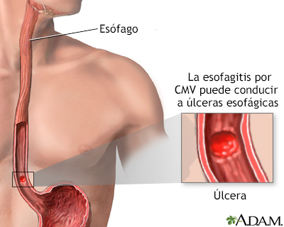 Esofagitis por CMV