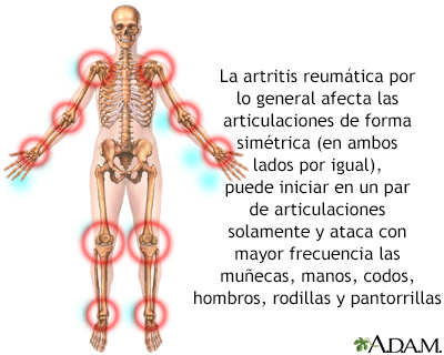 Artritis reumatoide - Miniatura de ilustración
              