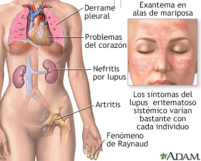 Lupus eritematoso sistémico - Miniatura de ilustración
              