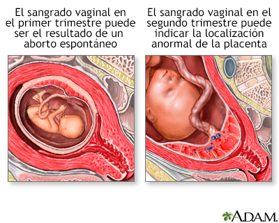 Sangrado vaginal durante el embarazo