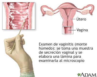 Prueba de vaginitis (montaje húmedo)