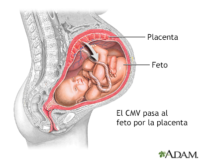 Citomegalovirus congénito - Miniatura de ilustración
              