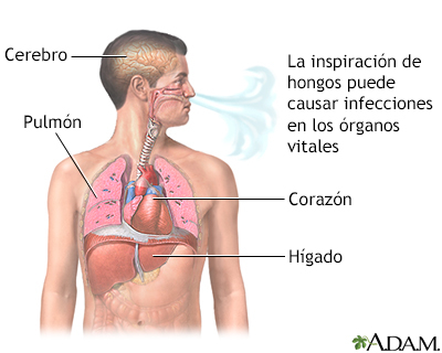 Coccidioidomicosis diseminada - Miniatura de ilustración
              