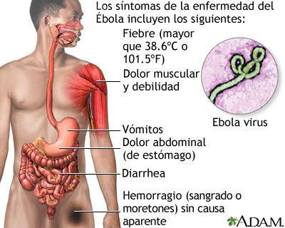 Enfermedad por el virus del Ébola - Miniatura de ilustración
              