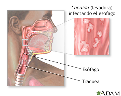 Esofagitis por Candida - Miniatura de ilustración
              
