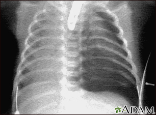 Neumotórax - radiografía de tórax - Miniatura de ilustración
              