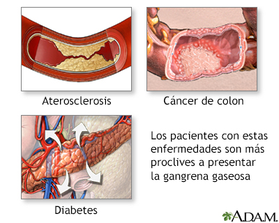 Gangrena gaseosa - Miniatura de ilustración
              