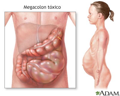 Megacolon tóxico - Miniatura de ilustración
              