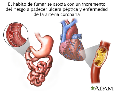 Tabaco y enfermedad vascular - Miniatura de ilustración
              