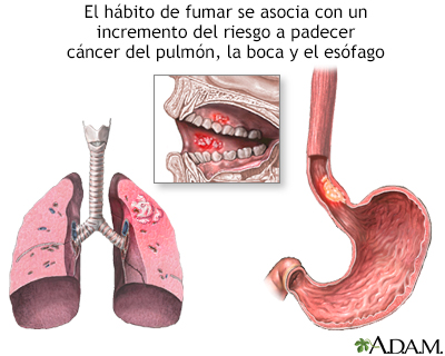 Tabaco y cáncer - Miniatura de ilustración
              
