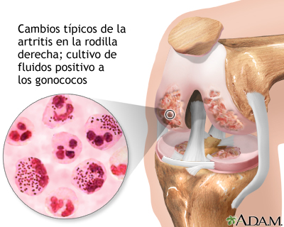 Artritis gonocócica - Miniatura de ilustración
              