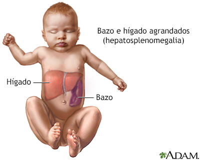 Hepatoesplenomegalia