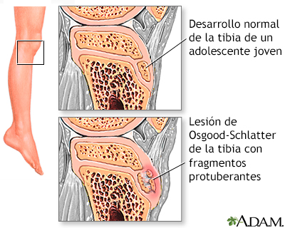 Dolor de pierna (lesión de Osgood-Schlatter) - Miniatura de ilustración
              