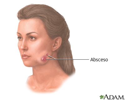 Actinomicosis (mandíbula hinchada) - Miniatura de ilustración
              