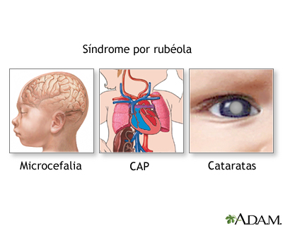 Síndrome de la rubéola - Miniatura de ilustración
              
