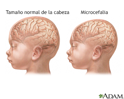 Microcefalia - Miniatura de ilustración
              