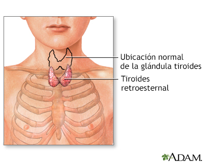 Tiroides retroesternal - Miniatura de ilustración
              